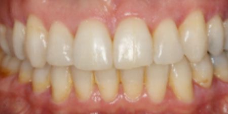 andrea's treatment at Heaton Mersey Orthodontic Centre