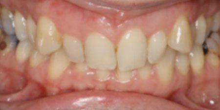 deborah's treatment at Heaton Mersey Orthodontic Centre