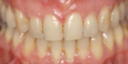 deborah's treatment at Heaton Mersey Orthodontic Centre