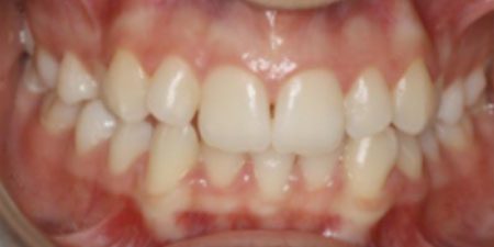 Georgia's treatment at heaton mersey orthodontic centre