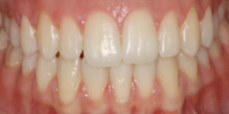 Georgia's treatment at heaton mersey orthodontic centre