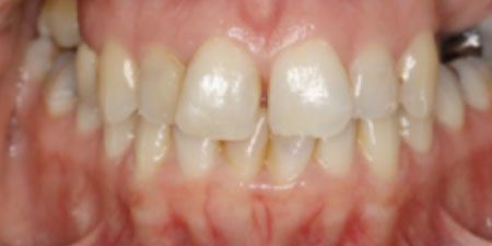 kelly's treatment at Heaton Mersey Orthodontic Centre