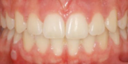 kelly's treatment at Heaton Mersey Orthodontic Centre