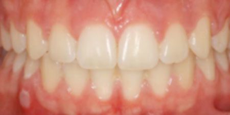 kelly's treatment at Heaton Mersey Orthodontic Centre