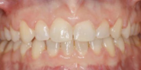 Lorraine's treatment at Heaton Mersey Orthodontic Centre