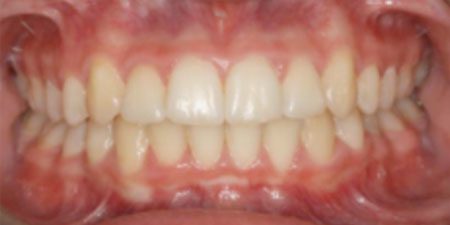 nina's treatment at Heaton Mersey Orthodontic Centre