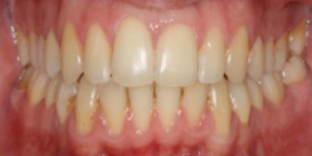 nina's treatment at heaton mersey orthodontic centre