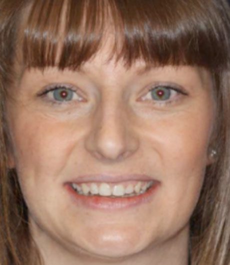 Lorraine's treatment at Heaton Mersey Orthodontic Centre