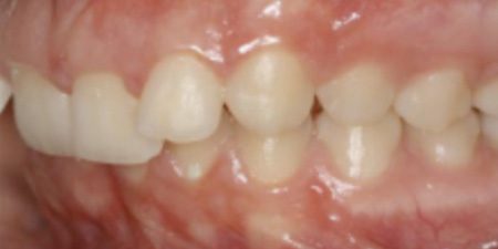 freya's treatment results at heaton mersey orthodontic centre