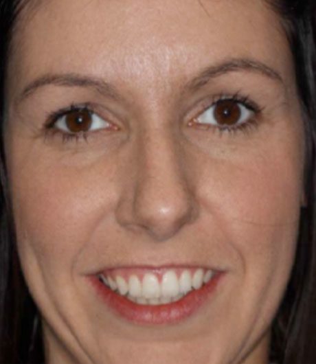 heather's smile makeover treatment at heaton mersey orthodontic centre