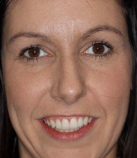 heather's smile makeover treatment at heaton mersey orthodontic centre