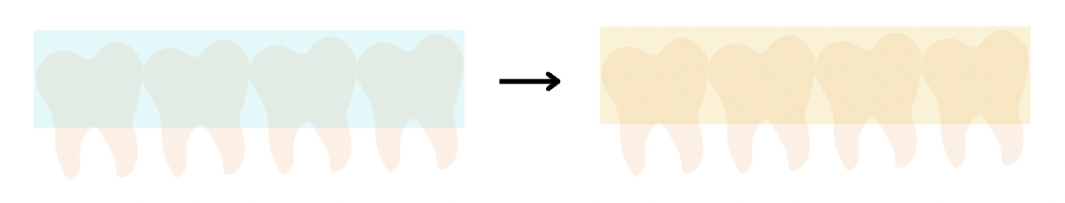 Graphic of teeth with Invisalign braces turning yellow / cloudy (Invisalign Stockport)
