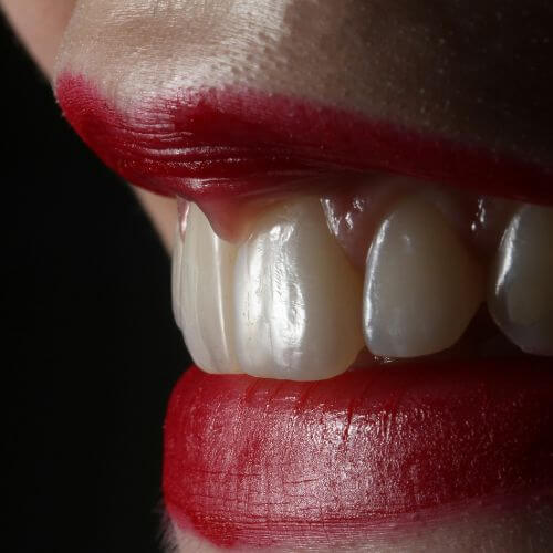 Close up of straight teeth after Invisalign treatment in Manchester