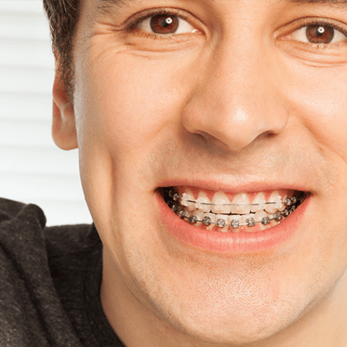 man with braces to close gaps smiling in Stockport, Manchester