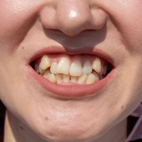 Woman's teeth before teeth straightening - treatment at Heaton Mersey orthodontic centre in Manchester