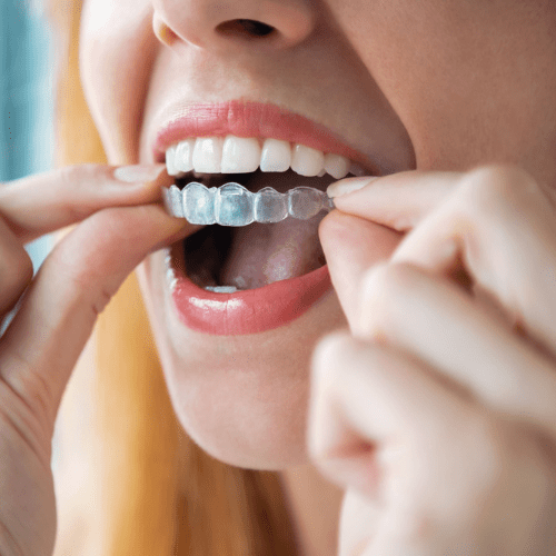 Woman putting in her clear aligners.