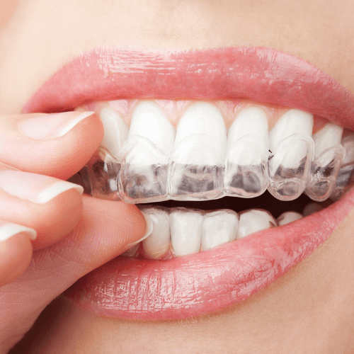 Woman putting in clear aligners.